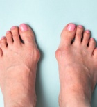 בוהן קלובה - הלוקס ולגוס: מה זה ואיך מטפלים?-תמונה